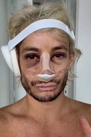 His Instagram followers were in awe as they discovered the results - but some had mixed feelings as they believed he had no need for the gruesome surgery