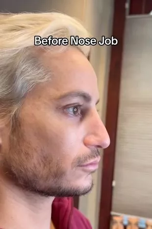 Frankie Grande underwent a subtle change as he opted for a nose operation